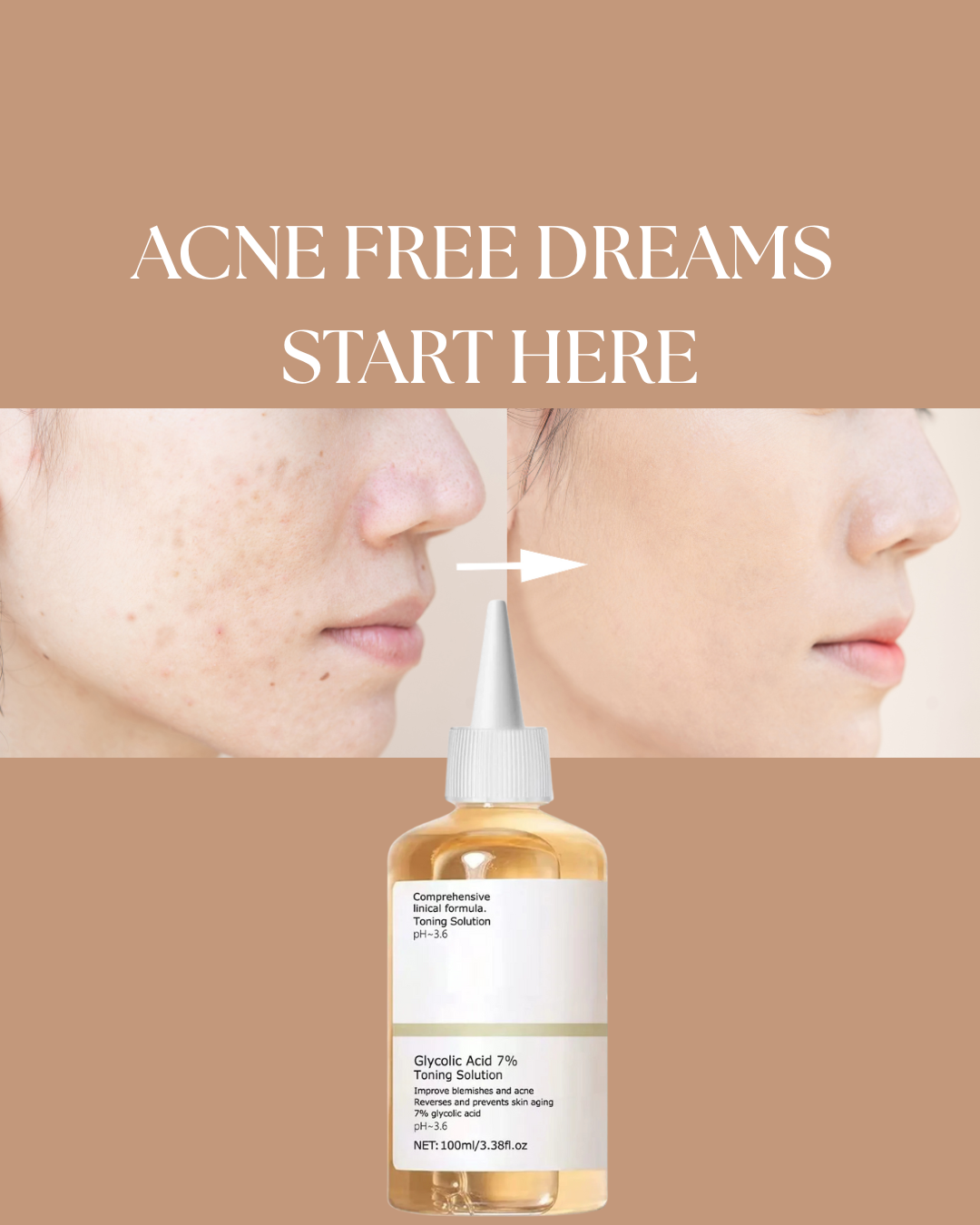 Glycolic Acid 7% Toner- Glow in. Acne out.